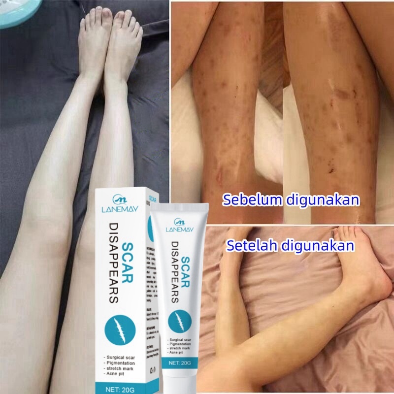 Penghilang bekas luka Penghilang bekas luka hitam koreng Penghilang Strechmark Cream Gel menghilangk
