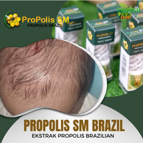 Obat Kepala Bayi Koreng Dan Bau Amis, Obat Penghilang Koreng di Kepala, Koreng di Kepala, Obat Salap