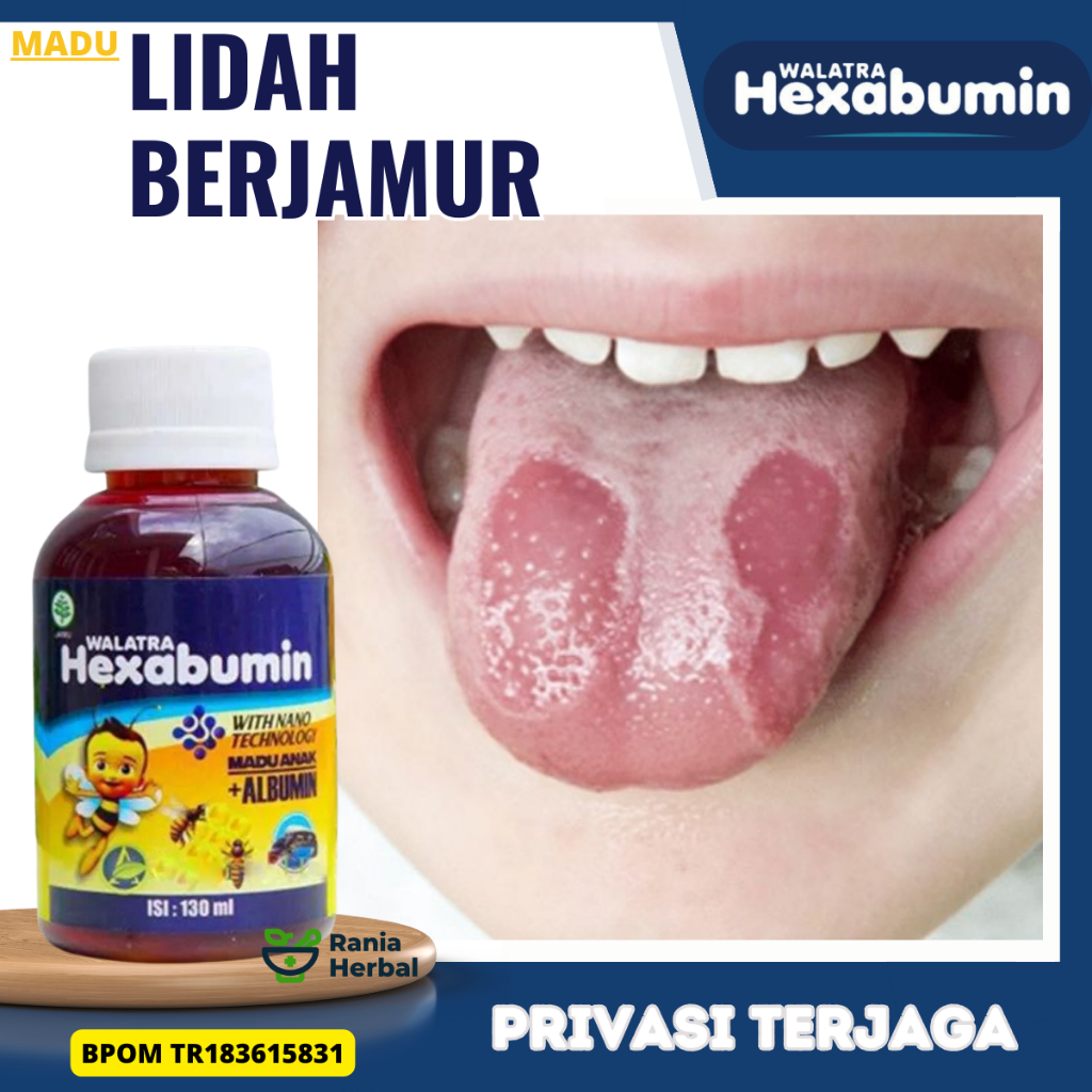 Obat Jamur Di Lidah Anak, Obat Lidah jamuran Anak,  Obat Candidiasis Lidah, eObat Lidah Putih, Obat 