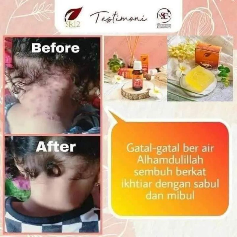 Sabun Gatal Alergi Bentol Bruntusan Biang Keringat Kudis Kurap Panu Eksim Kutu Air Penghilang Bekas 