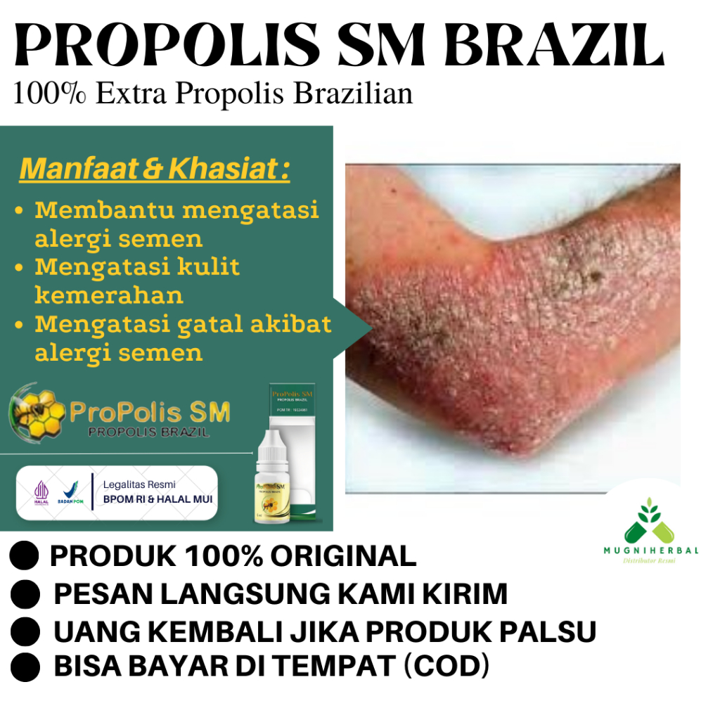 Propolis SM - Obat Alergi Semen, Gatal Kulit Alergi Semen, Dermatitis, Ruam Di Kaki Kemerahan, Alerg