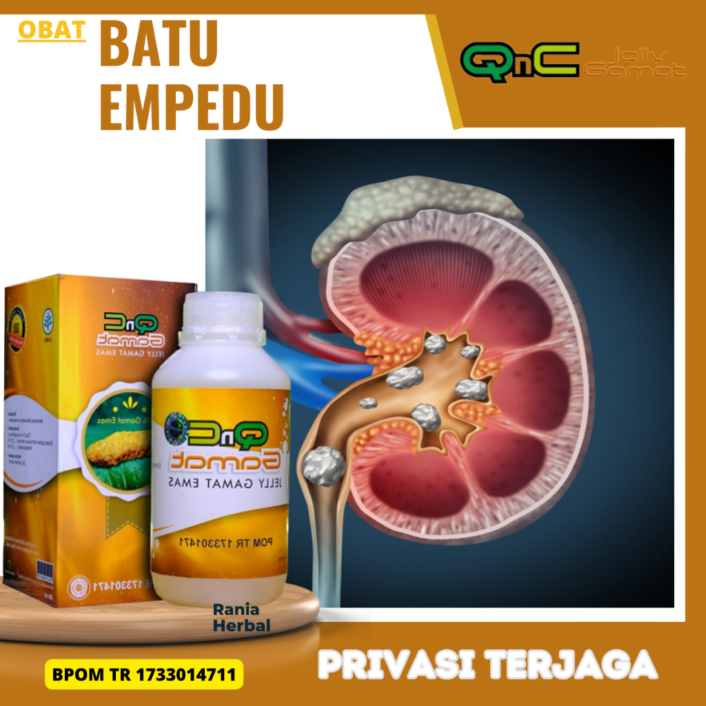 Obat Batu Empedu, Obat Penghancur batu Empedu, Obat Herbal Penghancur Batu Empedu, Obat Peluruh Batu