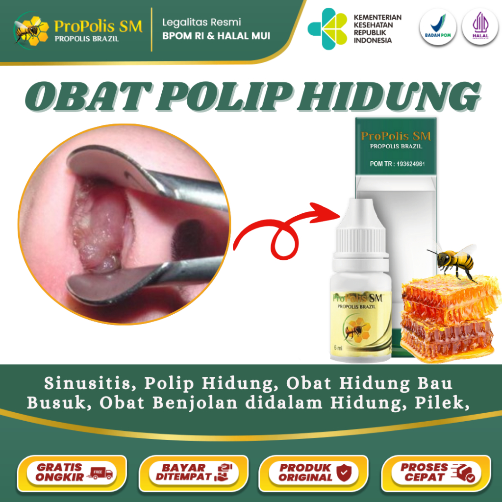 Obat Polip Hidung Sinusitis Hidung Tersumbat Benjolan Didalam Hidung Infeksi Polip Dengan Propolis S
