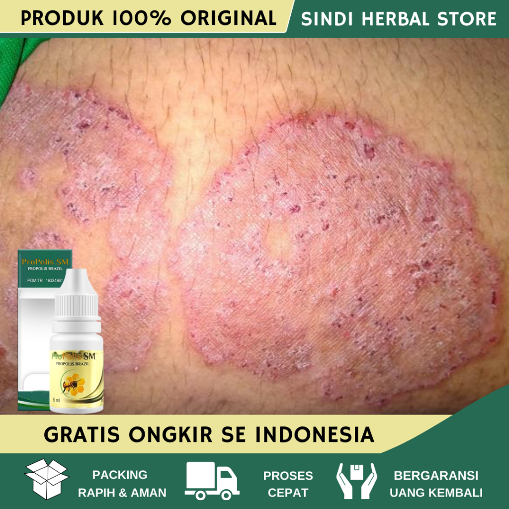 Obat Gatal Pantat, Obat Pantat Burik, Obat Gatal Pantat Dan Selangkangan, Obat Pantat Bruntusan, Oba