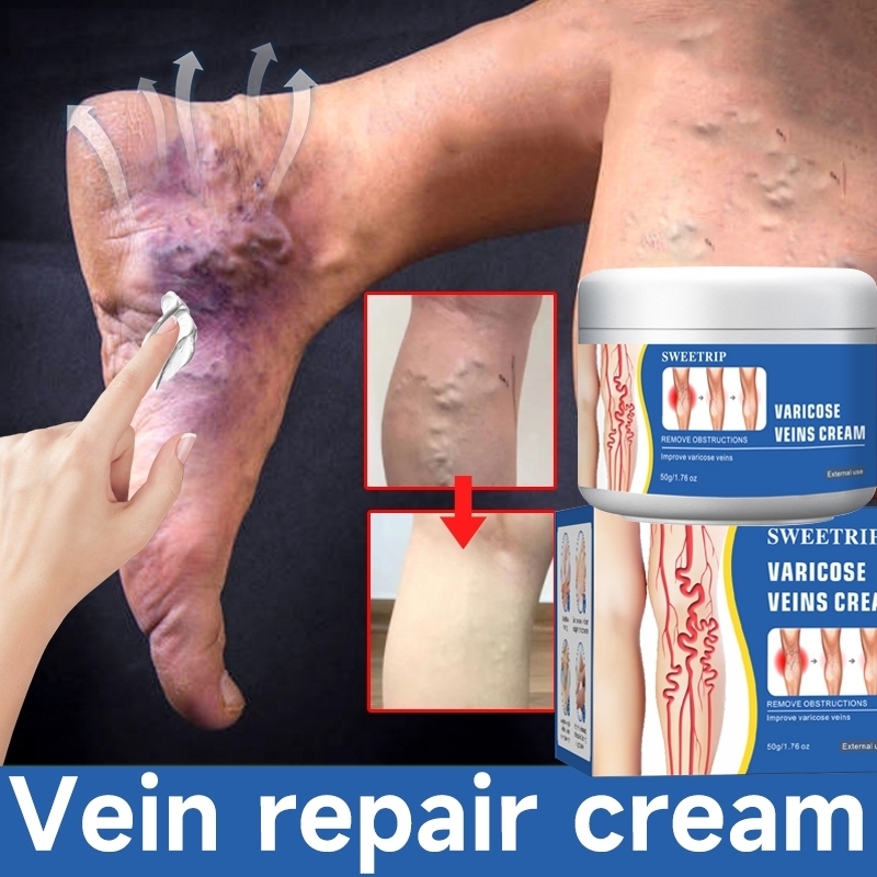 SWEETRIP Varicose Veins Cream Obat Varises Salep Penghilang Varises Vaskulitis /Ampuh Tanpa Operasi 