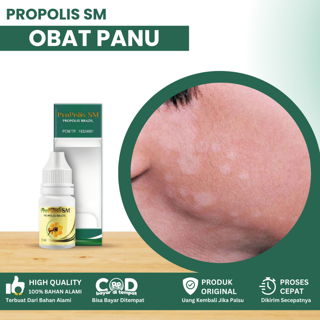 Obat Panu Di Wajah Anak Dan Dewasa, 0bat Jamur Kulit Di Wajah, Obat Menghilangkan Panu Di Wajah, Pen