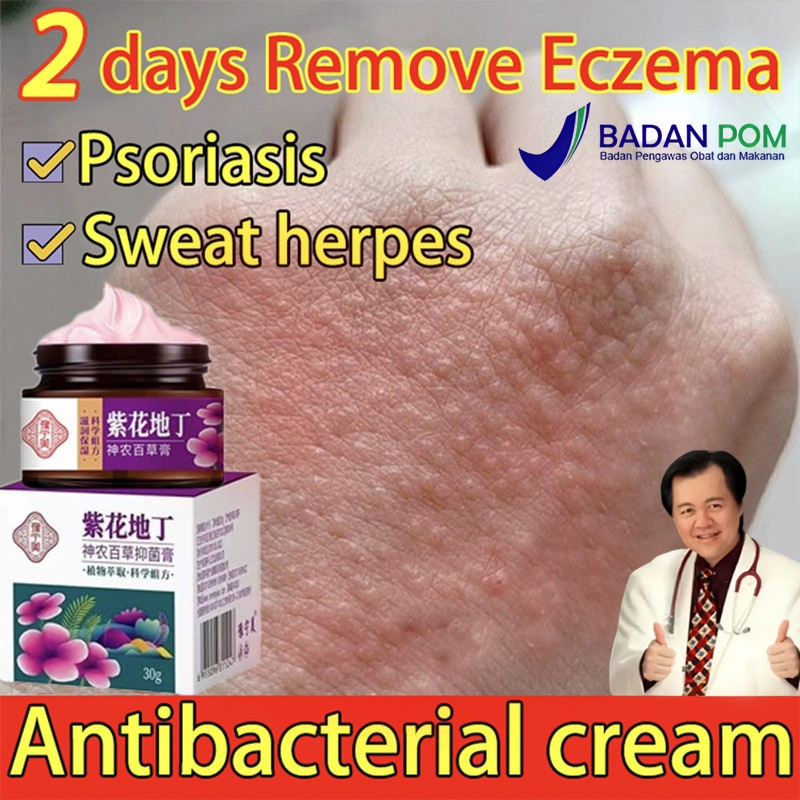 Salep gatal paling ampuh obat gatal selangkangan salap gatal kulit yang ampuh obat gatal paling ampu