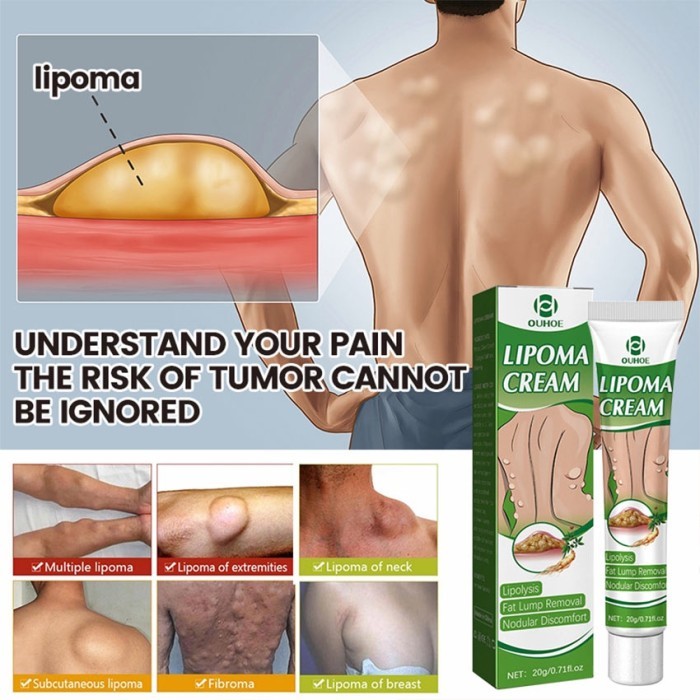 SUMIFUN LIPOMA CREAM SALEP HERBAL ORIGINAL