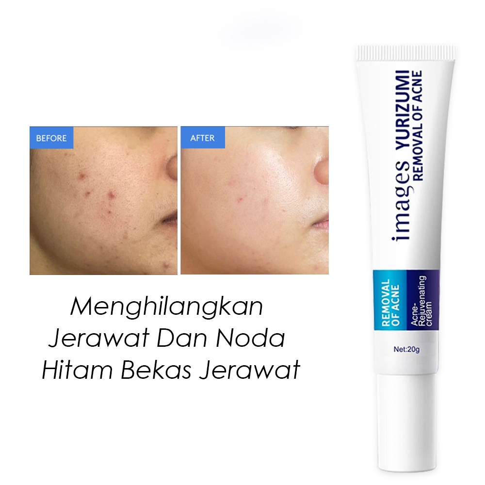 Images Yurizumi Acne Removal Cream Mengobati Jerawat Memudarkan Bekas Jerawat