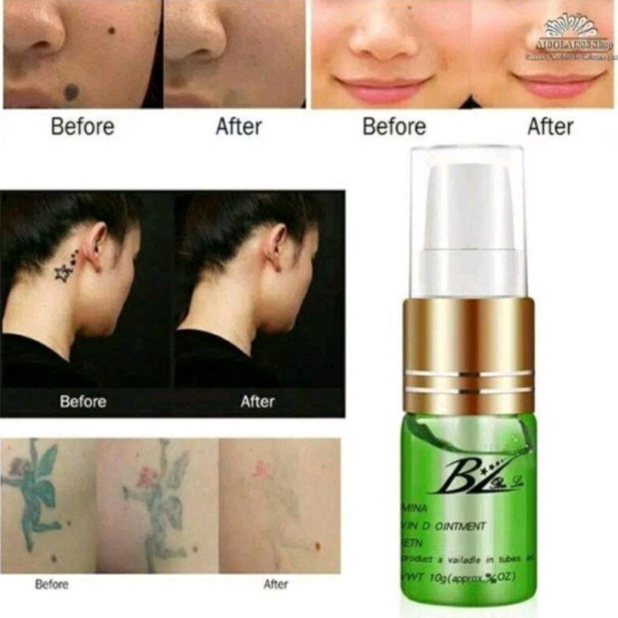 KODE F15N Movaro Tato Remover Penghilang Tato plz