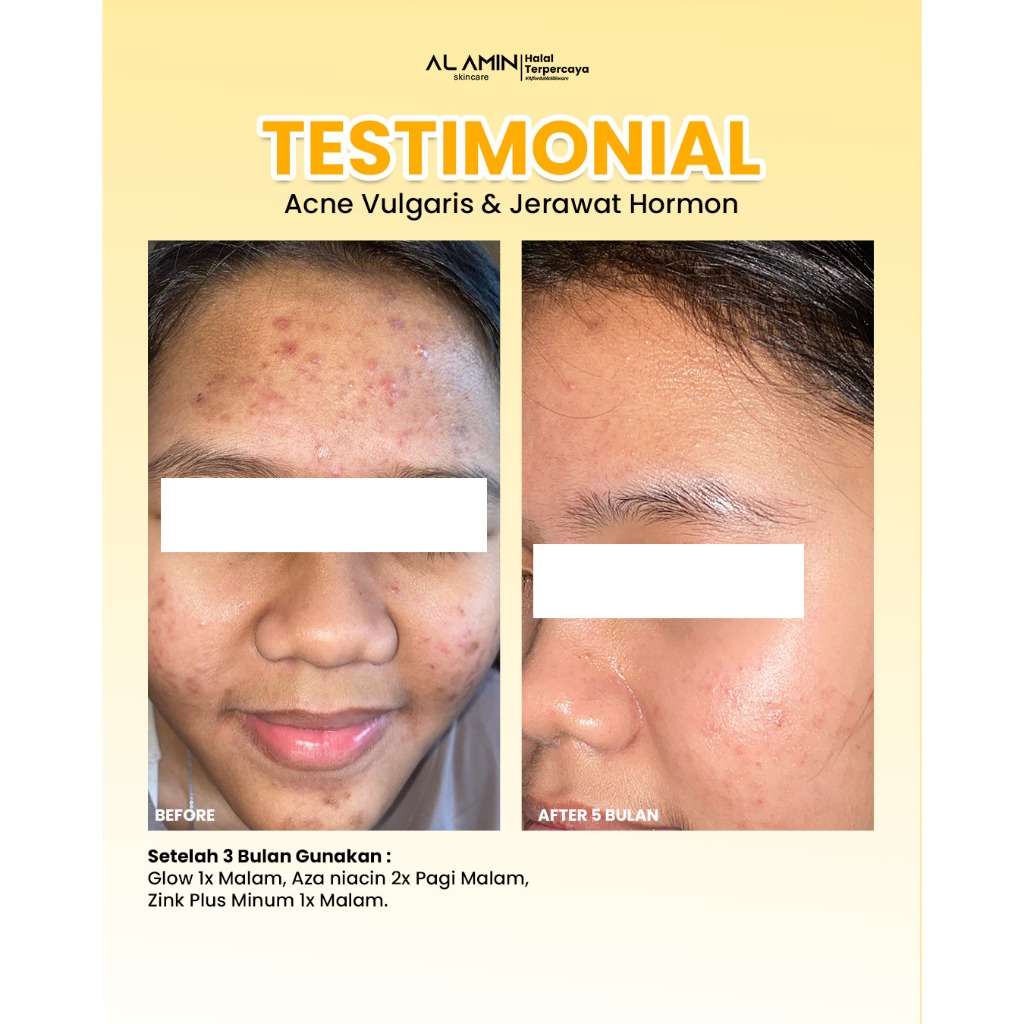Alamin Post Acne Cream Azza Niacin penghilang Bekas Jerawat Merah Noda Hitam Ndk78