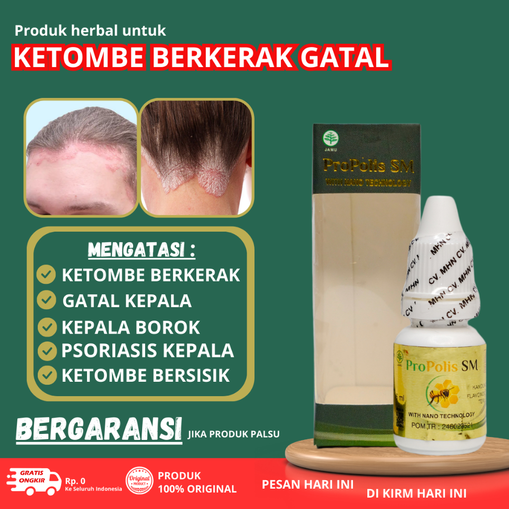 Obat Jamur Kepala Kering - Salep Borok Kepala - Obat Psoriasis Kulit Kepala - Obat Kepala Berkerak K
