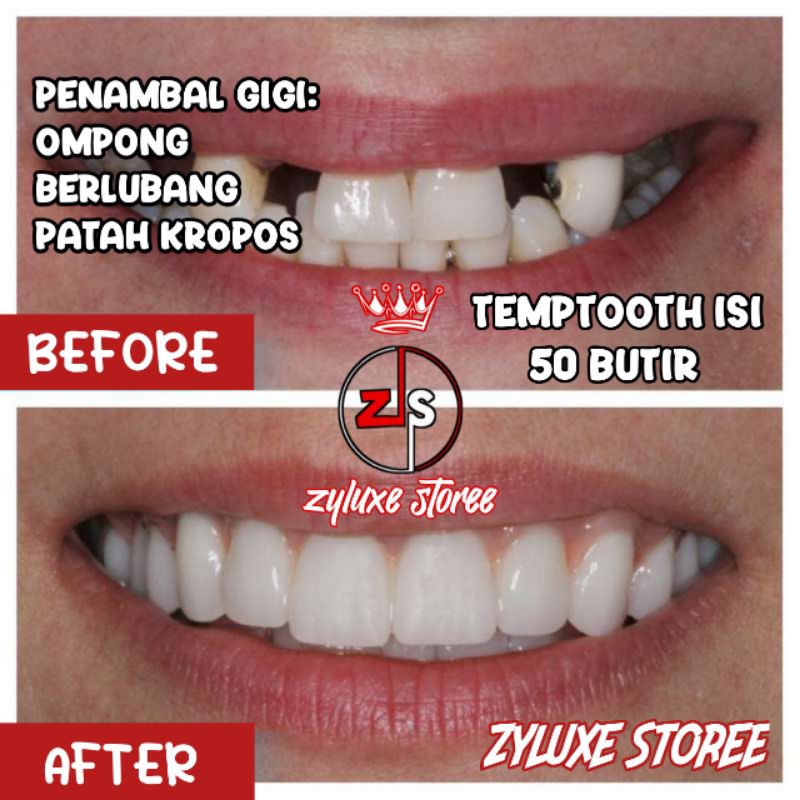 Termurah TEMPTOOTH 50 Butir Penambal Gigi Berlubang/Gigi Palsu Sementara