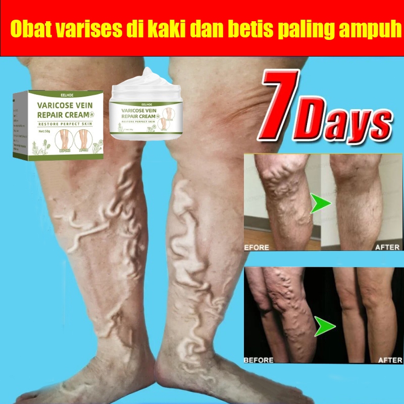 Obat varises di kaki dan betis paling ampuh Varicose Veins Cream Salep Penghilang Varises Vaskulitis