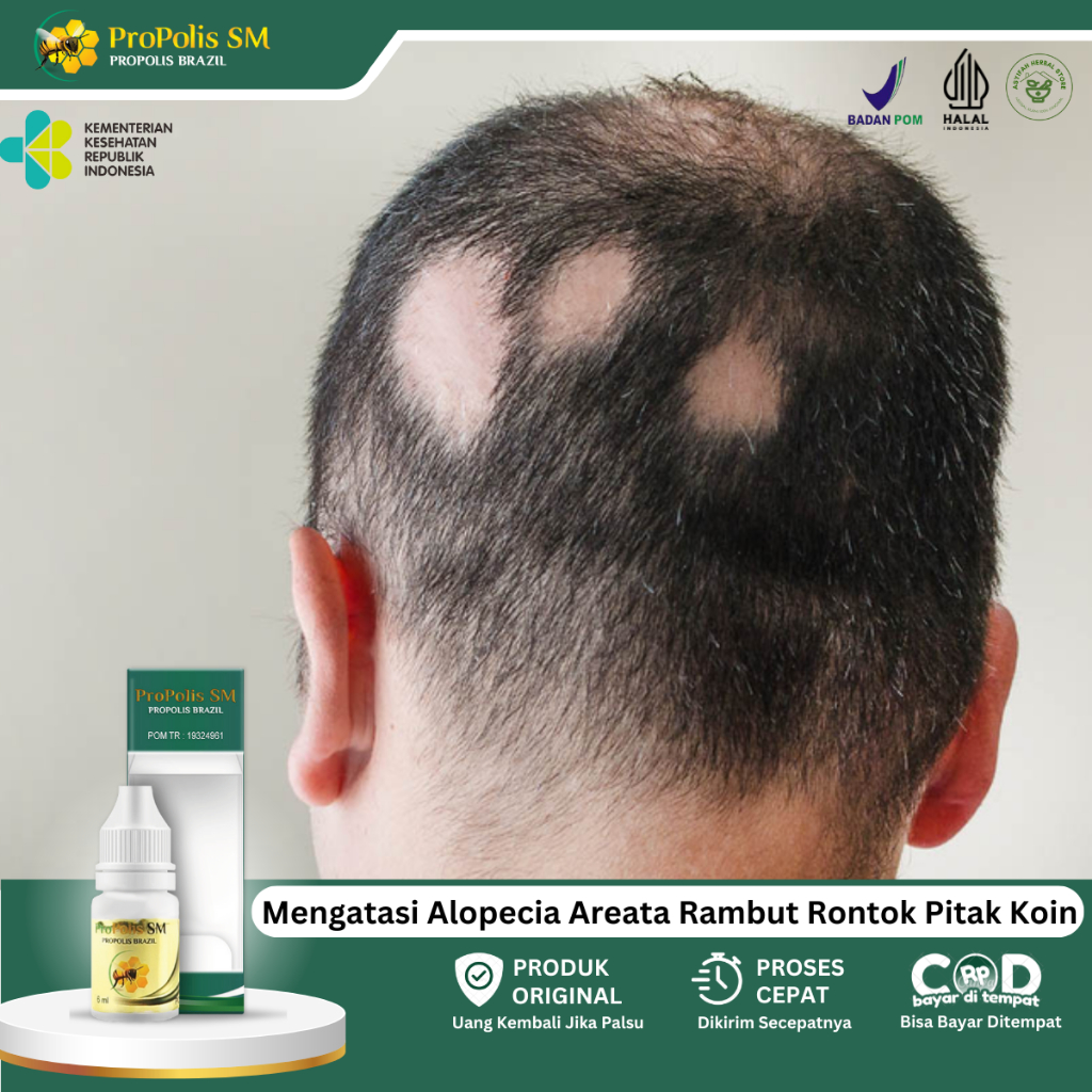 Obat Alopecia Areata, Rambut Rontok, Pitak Botak Koin, Penumbuh Rambut, Kebotakan Rambut Pada Kepala