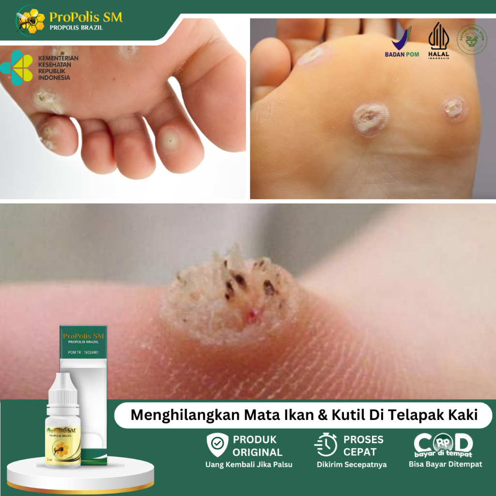 Obat Mata Ikan Di Telapak Kaki, Obat Penghilang Mata Ikan, Obat Mata Ikan, Obat Kutil Di Telapak Kak