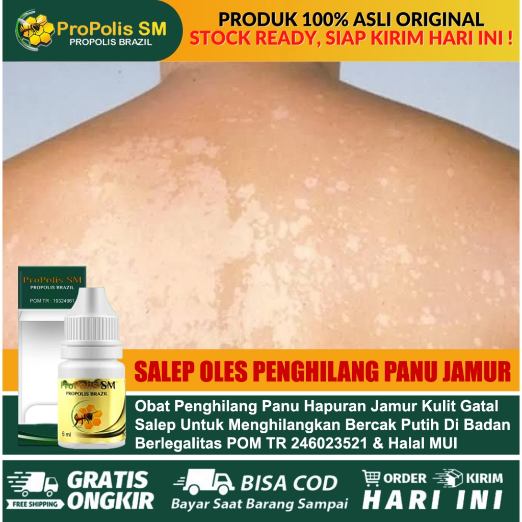 Obat Penghilang Panu Obat Panu Menahun Bercak Putih Obat Jamur Kulit | Propolis SM