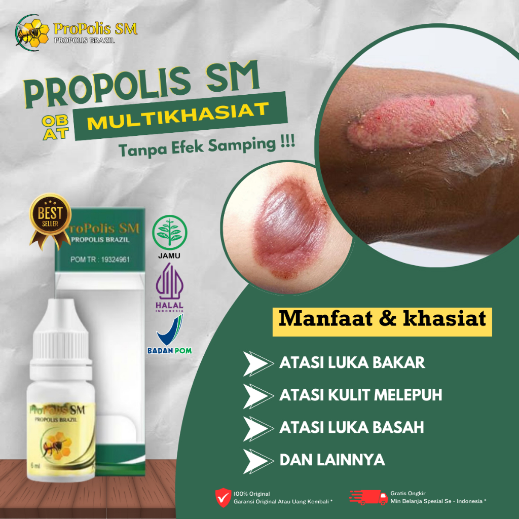 Obat Luka Bakar, Obat Oles Pengering Luka Bakar, Obat Penghilang Bekas Luka Bakar, Obat Pengering Lu