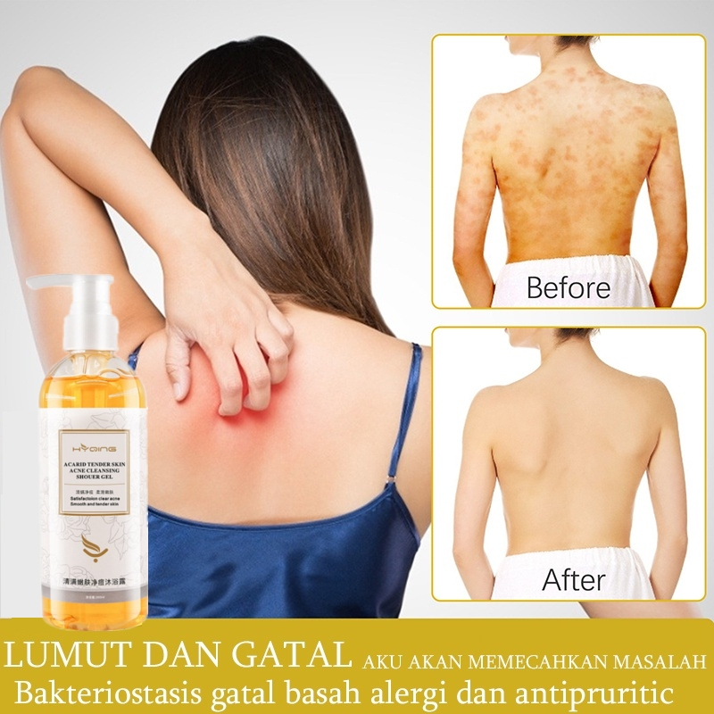 Eczema Body Wash Obat Gatal Gatal Kulit Pengobatan Eksim Psoriasis Eksim Kering Kurap Gatal Kulit Ja