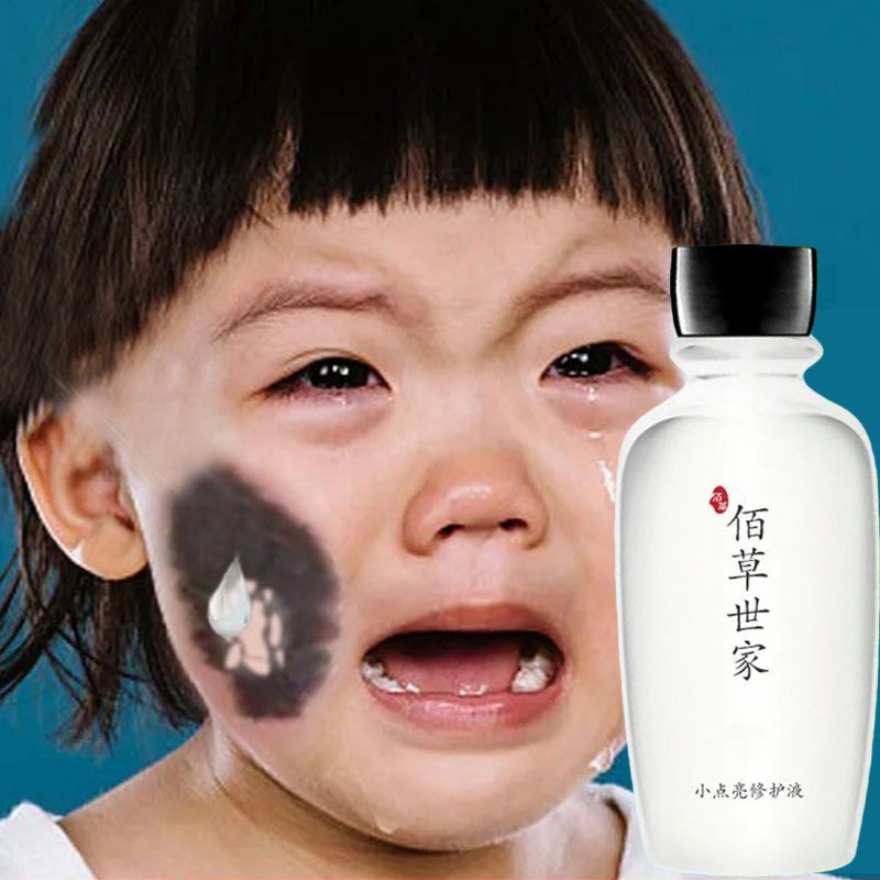 Obat Penghilang Tanda Lahir Memudarkan Tanda Lahir Hitam Hemangioma Tanda Lahir Merah Menonjol Pada 