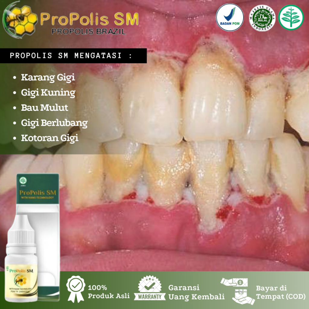 Obat Tetes Karang Gigi, Plak Gigi, Gigi Kuning, Bau Mulut Akibat Karang Gigi, Gigi Berkerak, Gigi Hi