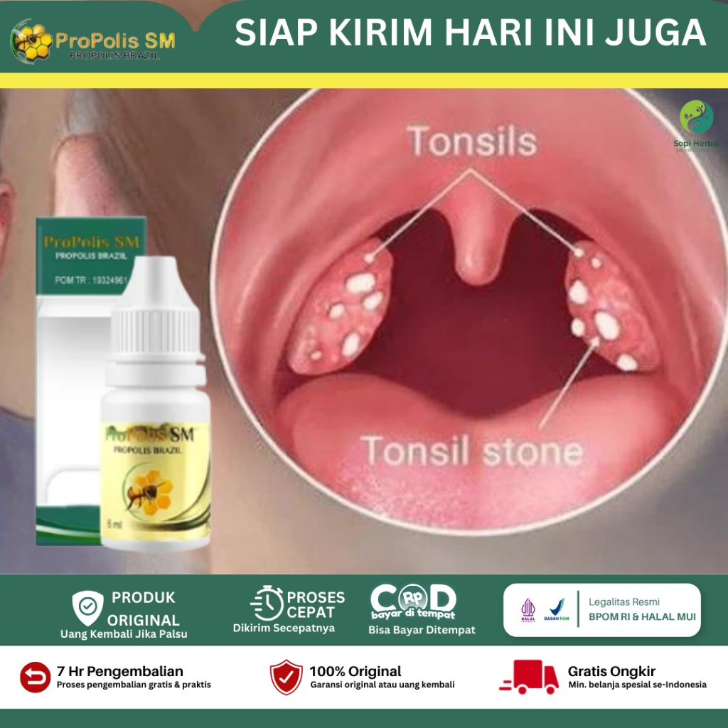 Obat Amandel, Obat Herbal Batu Amandel, Obat Untuk Amandel, Obat Amandel Anak dan Dewasa, Obat Radan