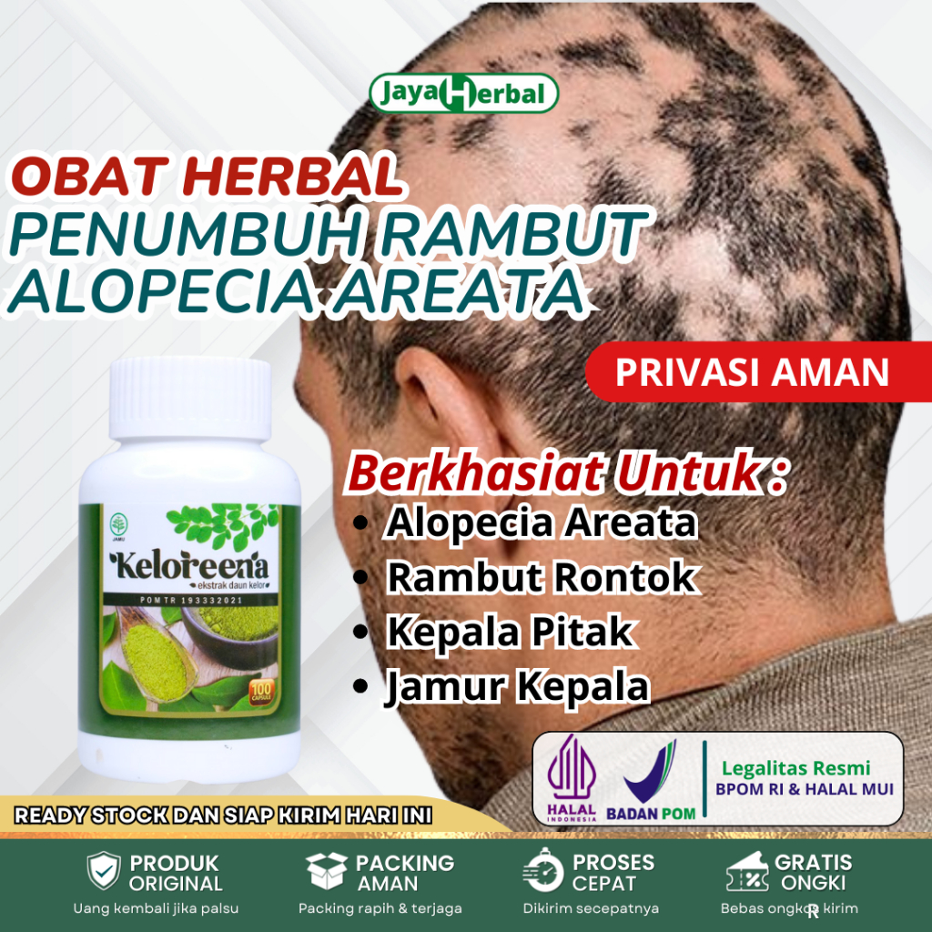 Obat Alopecia Areata, Penumbuh Rambut Botak, Obat Pitak, Obat Botak Koin, Obat Tinea Capitis, Obat P