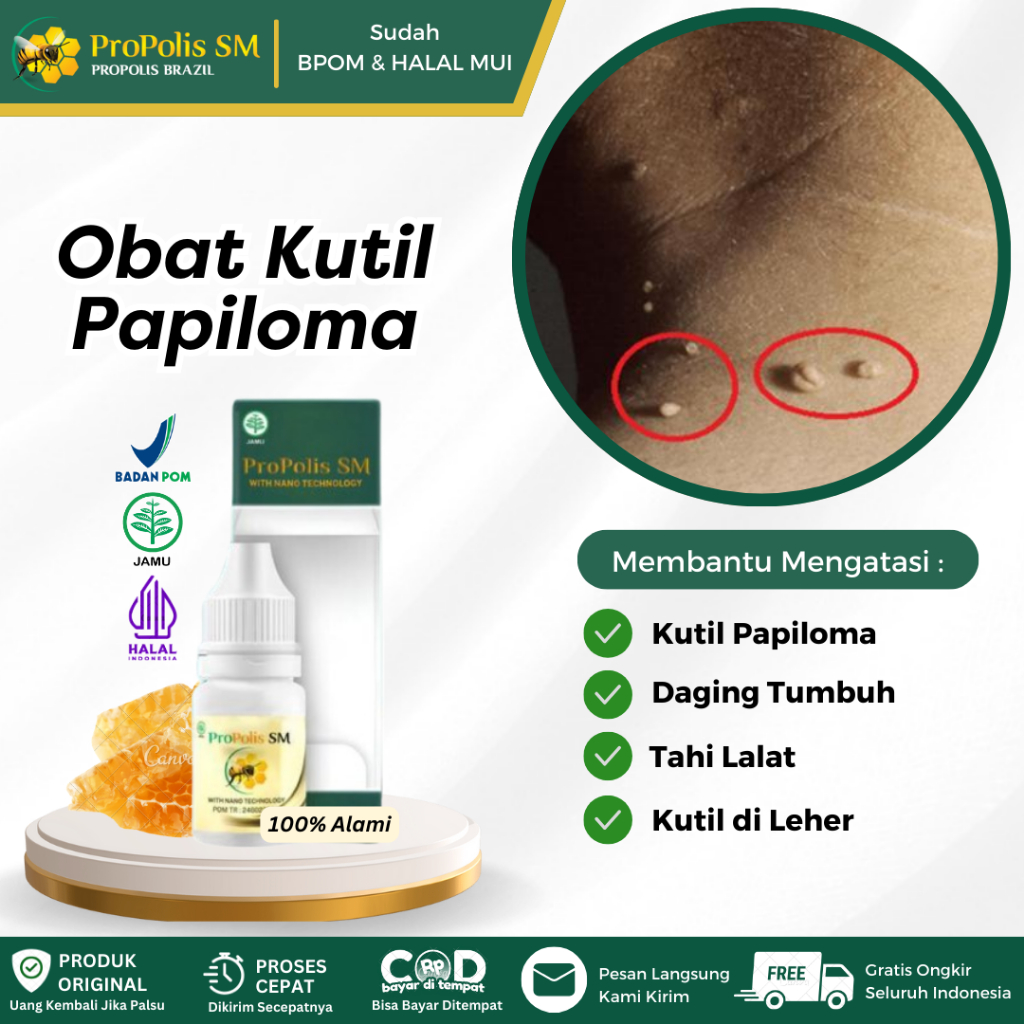 Propolis SM - Obat Perontok Kutil di Leher, Kutil Papiloma, Kutil di Jari Tangan, Skin Tag, Daging J