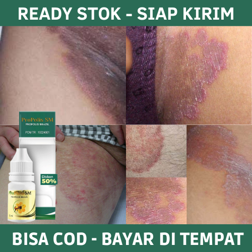Obat Selangkangan Hitam, Obat Gatal Selangkangan, Obat Selangkangan Gatal, Obat Selangkangan Gatal H