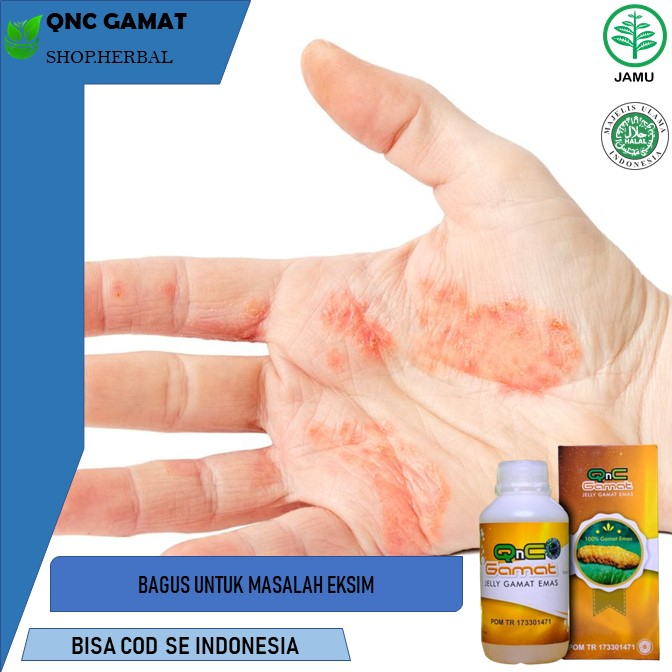 obat eksim Obat Eksim Kering Obat Kulit Eksim, Psoriasis, Gatal Gatal, Budug, Biduran, Borok Menahun