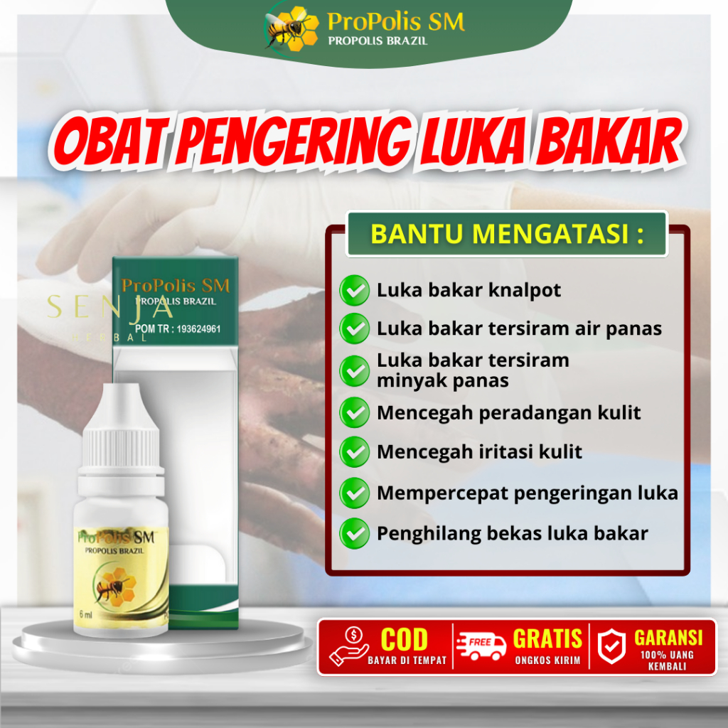 Obat Pengering Luka Bakar, Luka Bakar Tersiram Air Panas & Knalpot - PROPOLIS SM