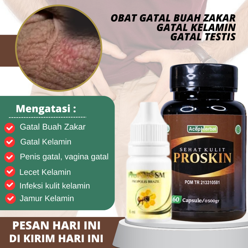 Propolis SM - Obat Ruam Di Buah Zakar, Obat Gatal Biji Pelir, Obat Gatal Testis, Obat Bentol Bernana