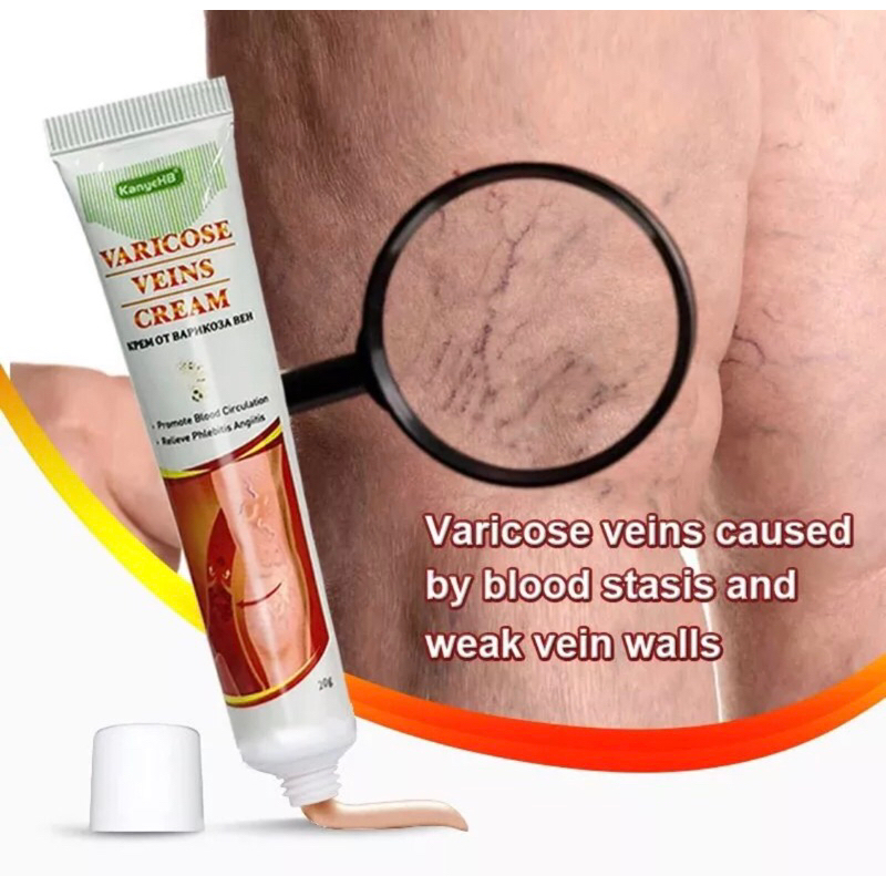 SALEP VARISES AMPUH VARISES KAKI VARISES BETIS SALEP VARISES KEMALUAN SALEP VARIKOKEL