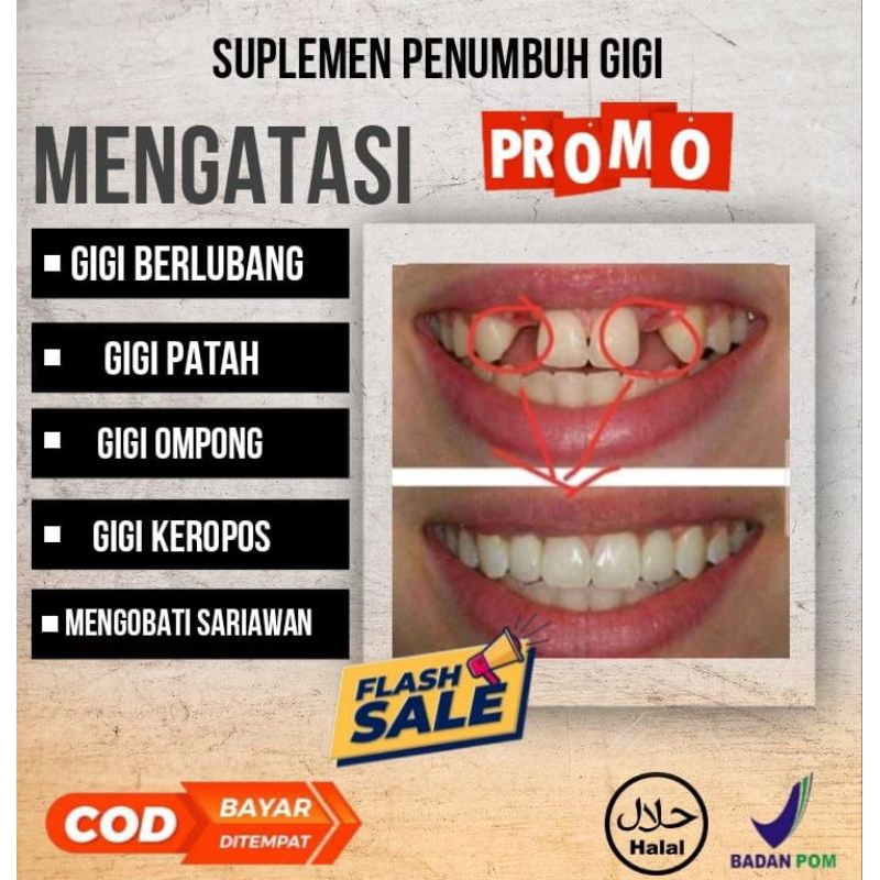 SUPLEMEN PENUMBUH GIGI BOLONG KROPOS DAN OMPONG PERMANEN