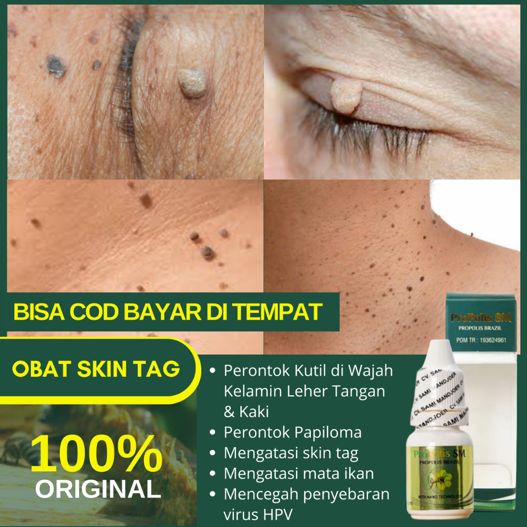 Obat Skin Tag Original, Obat Skin Tag di Leher, Penghilang Skin Tag di Wajah, Obat Herbal Skin Tag, 