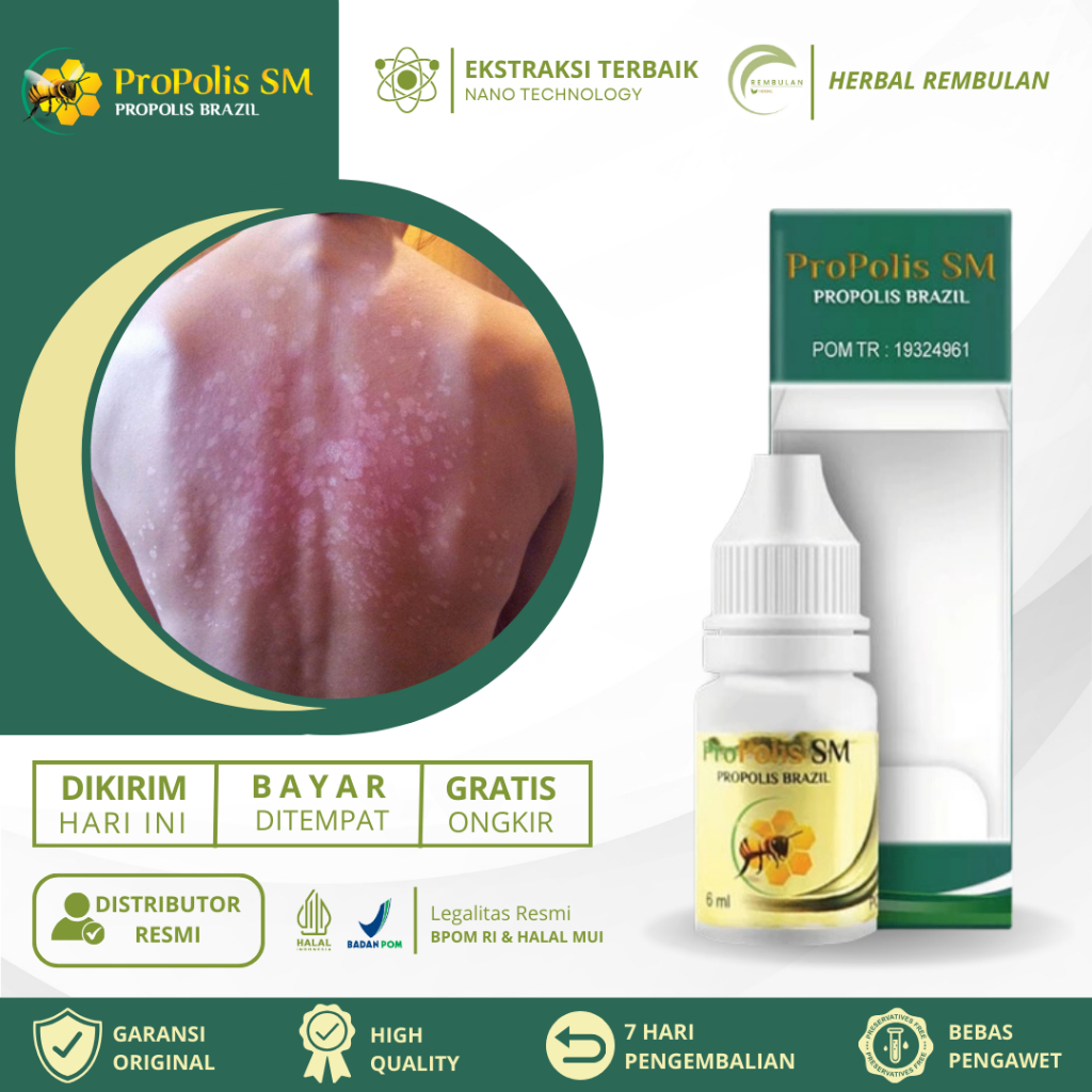 Obat Panu Cair, Obat Penghilang Panu, Hapuran Kulit, Jamur Kulit Panu, Salep Panu Balas Bogo, Obat P