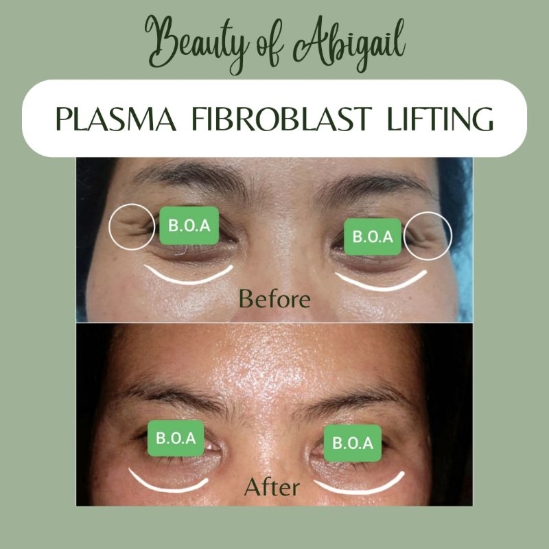 Plasma Fibroblast Lifting / Plasma Lifting / Plasma Lift