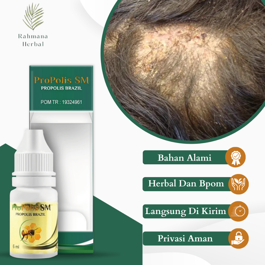 Obat Jamur Kepala, Obat Kurap Jamur Kepala Kulit, Obat Kulit Kepala Gatal, Obat Kepala Borok, Obat K