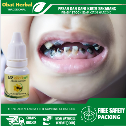 Obat Gigi Rusak, Obat Gigi Hitam, Obat Gigi Berlubang Hitam, Obat Gigi Rusak Pada Anak, Obat Ulat Gi