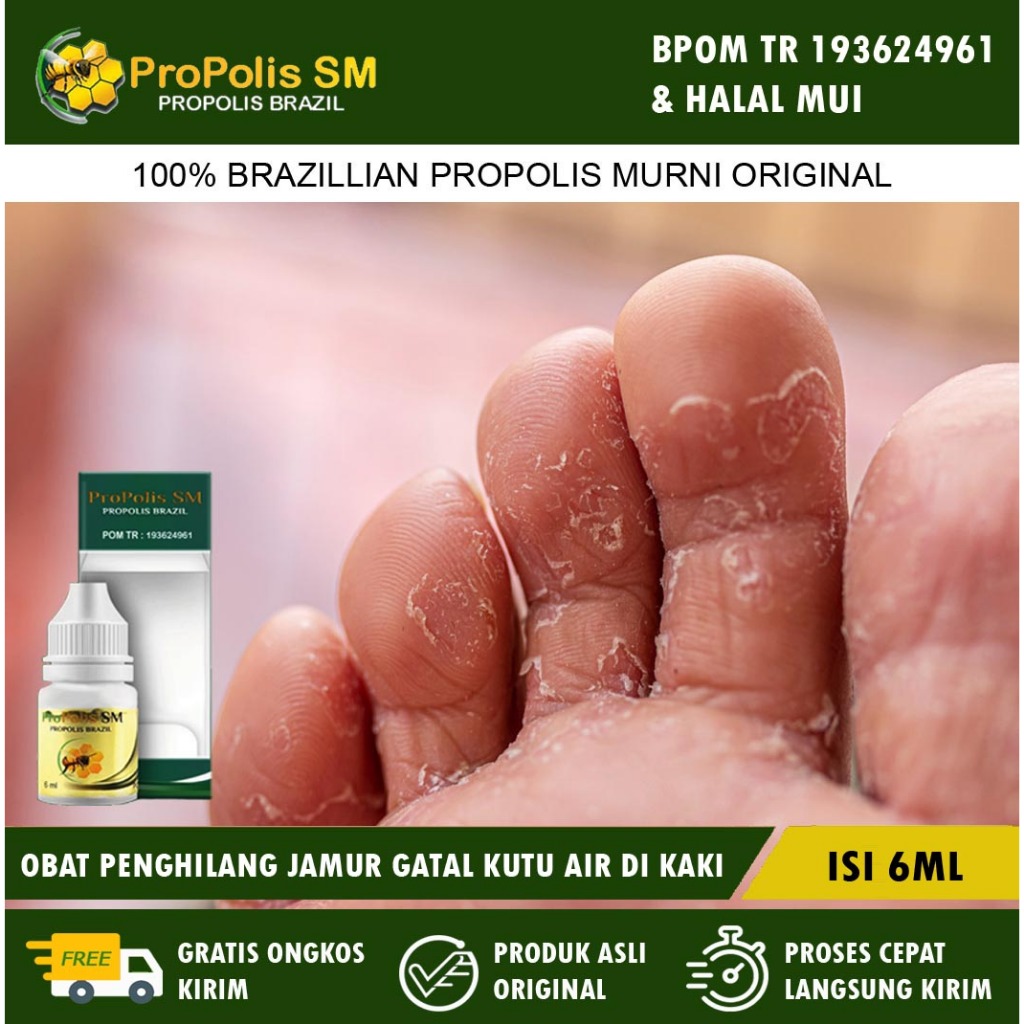 Obat Jamur Gatal Kutu Air, Obat Kutu Air Pada Telapak Kaki, Jamur Kaki, Penghilang Kutu Air