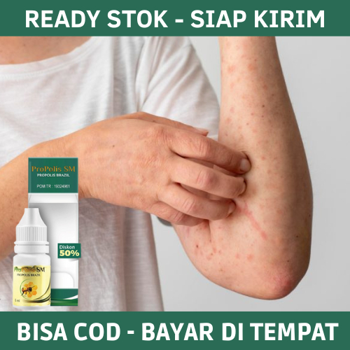 Obat Darah Manis, Obat Darah Manis dan Bekas Luka, Obat Penghilang Darah Manis, Obat Gatal Kulit Dar