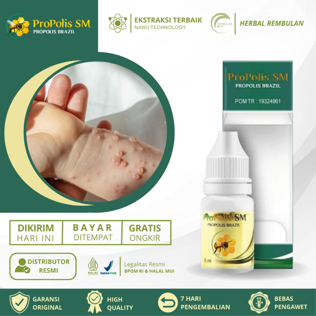 Obat Cacar Air, Salep Cacar Air, Obat Cacar Air & Bekas Cacar, Obat Cacar Air Di Apotik, Obat Gatal 