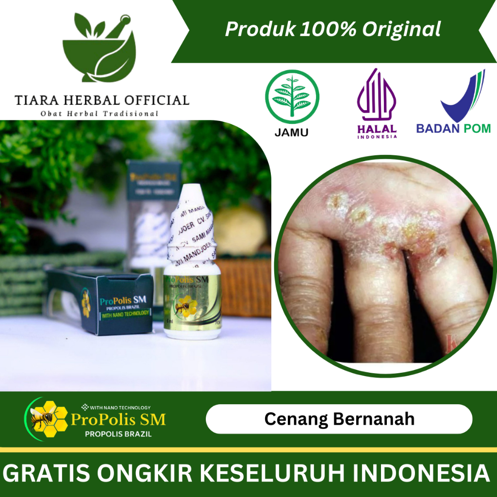 Obat Cenang Bernanah, Obat Telapak Tangan Dan Kaki Bernanah, Obat Kulit Nanahan, Obat Luka Borok Ber