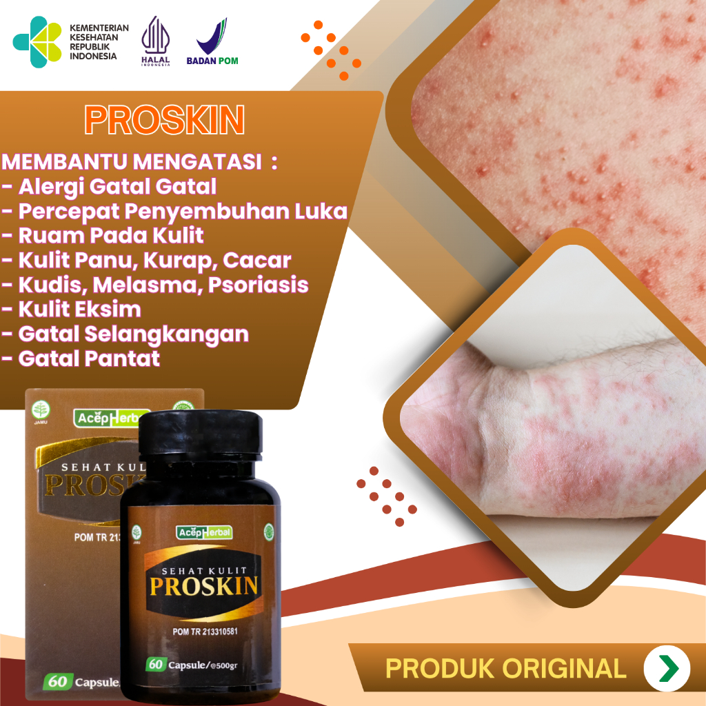 Obat Kulit Gatal & Alergi Gatal Menahun Atasi Gatal Eksim Penyakit Kulit Gatal Parah Gatel Selakanga