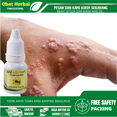 Obat Herpes Kulit, Obat Herpes Kelamin, Obat Herpes Bibir, Obat Herpes Zoster, Obat Gatal Berair Men