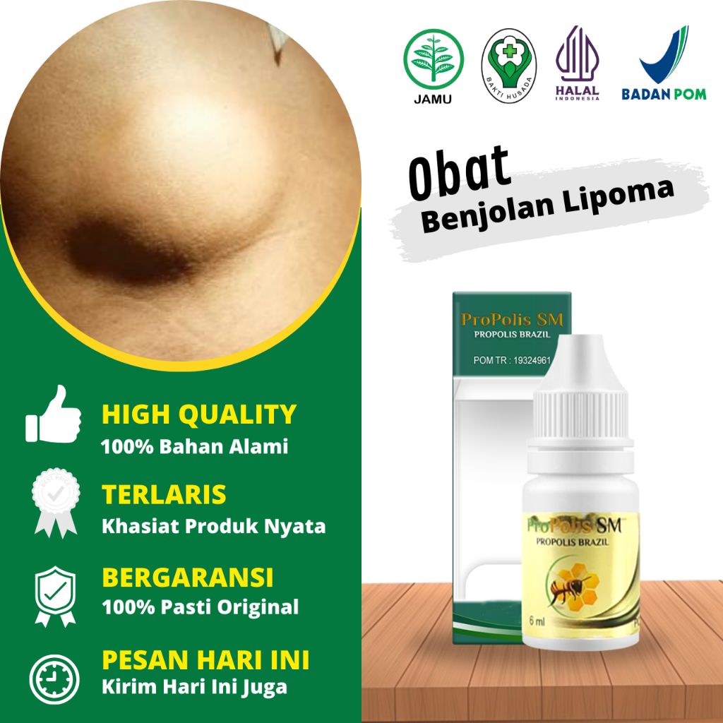 Obat Oles Penghilang Benjolan Lipoma Di Tangan, Obat Benjolan Lipoma Di Punggung, Obat Benjolan Lipo