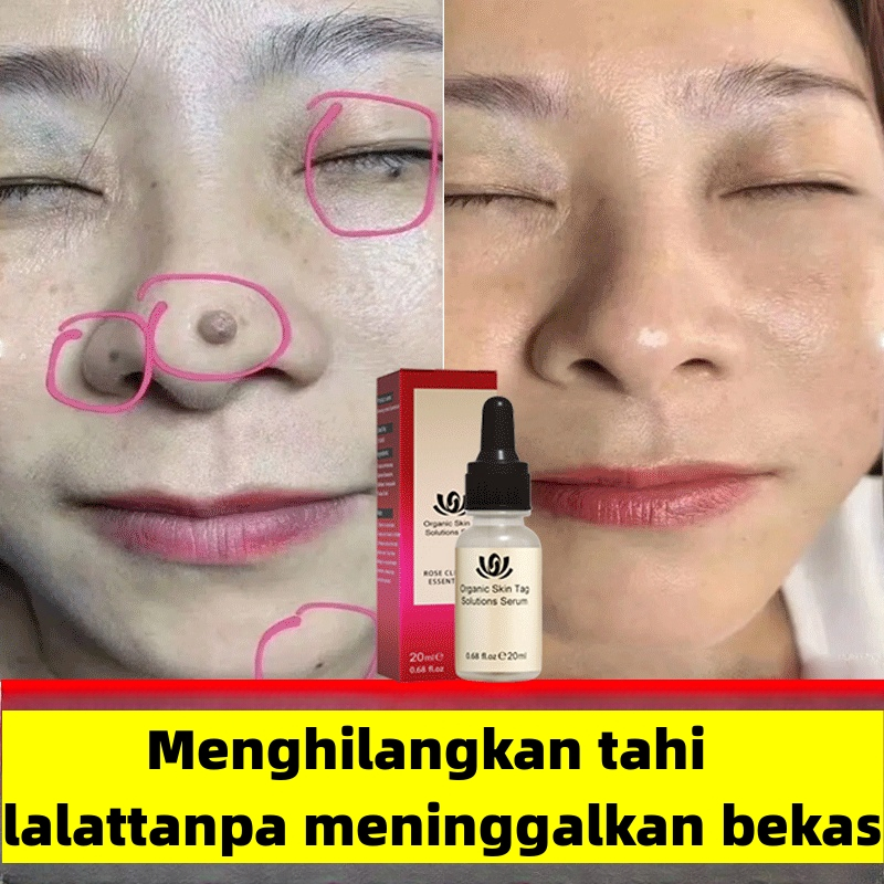 【Bpom&cod】Obat Penghilang Tahi Lalat Penghilang kutil Skin tag Remover Tahi Lalat Menghilangkan Pali