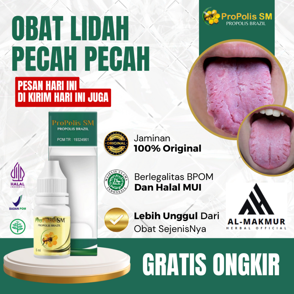 Obat Lidah Pecah Pecah, Obat lidah Berjamur, Obat Sakit Lidah, Obat Lidah Pecah Sariawan, Obat Lidah