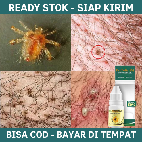 Obat Kutu Kelamin, Obat Kutu Kemaluan Pria, Obat Kutu Kemaluan Wanita, Obat Pembasmi Kutu Kemaluan, 