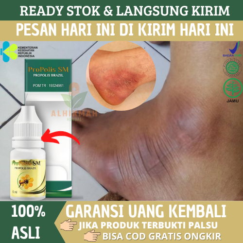 Obat Mata Kaki Hitam Kapalan Kering Dan Kasar, Obat Mata Kaki Luka Lecet Karena Gesekan Sendal / Sep